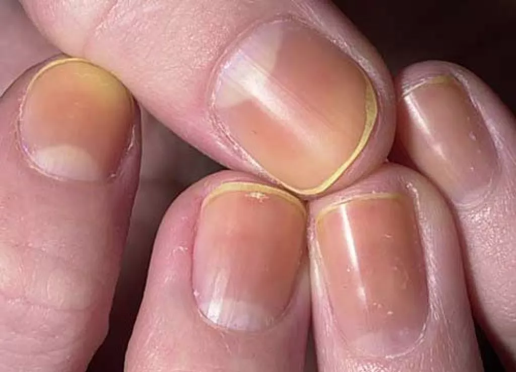 6 Things Your Fingernails Can Tell You About Your Health