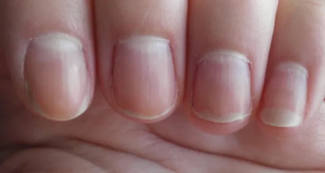 6 Things Your Fingernails Can Tell You About Your Health